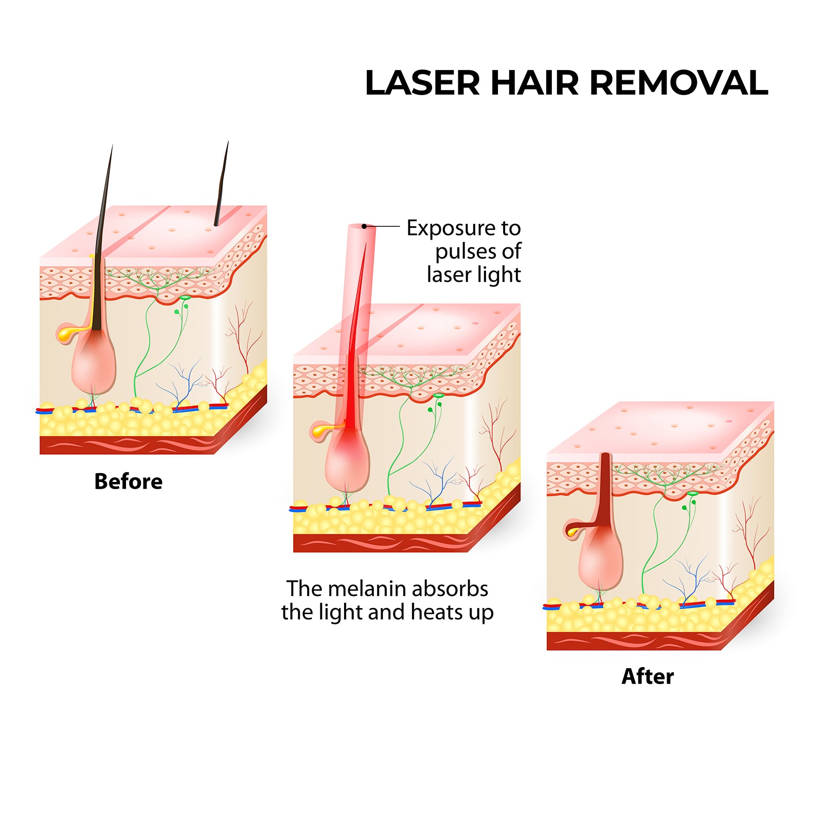 Silhouette Portable Laser Hair Remover Permanent Epliation System for Body & Face
