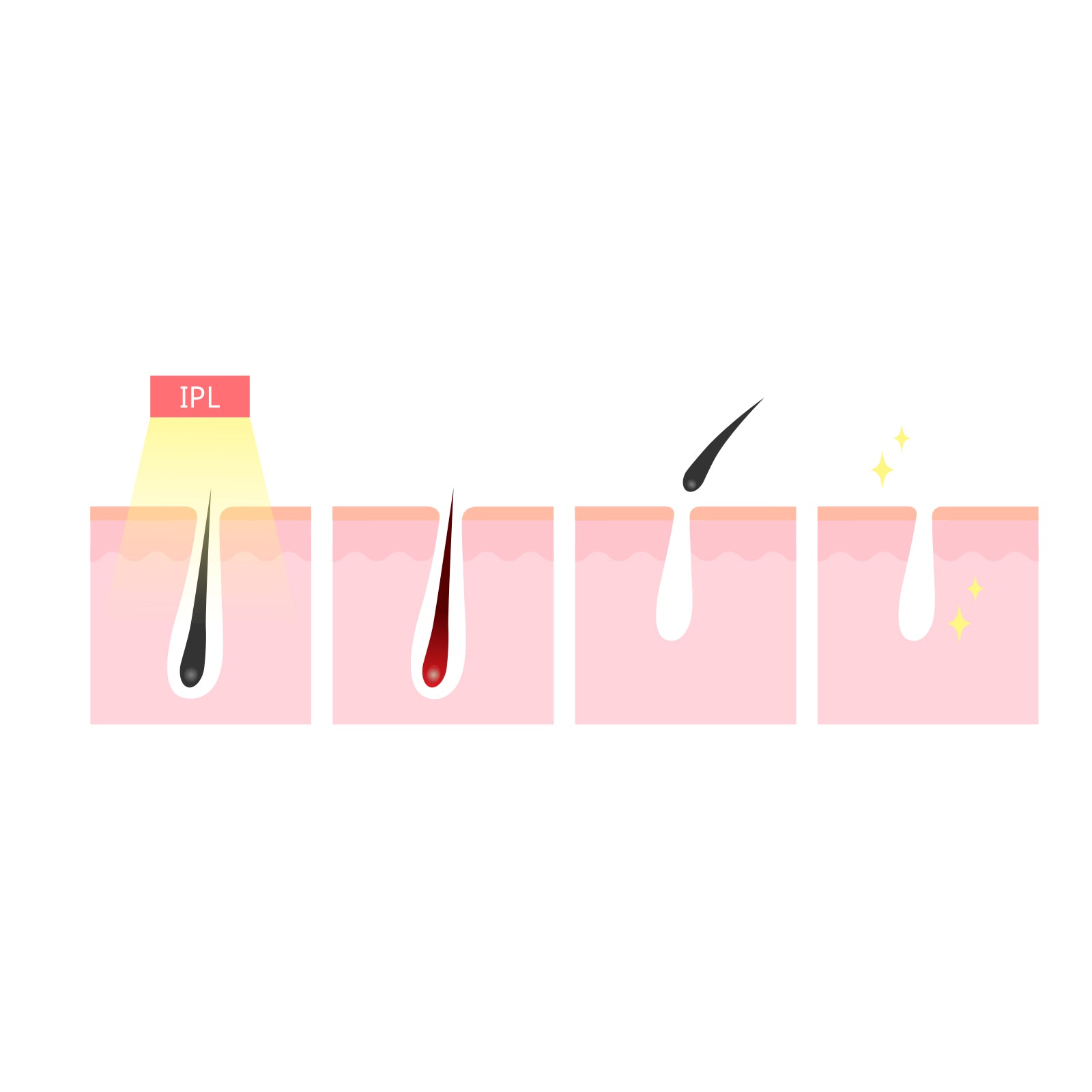 Silhouette Portable Laser Hair Remover Permanent Epliation System for Body & Face
